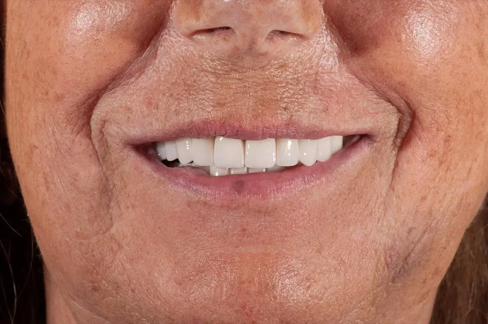 Zirconium crowns: the same patient after treatment