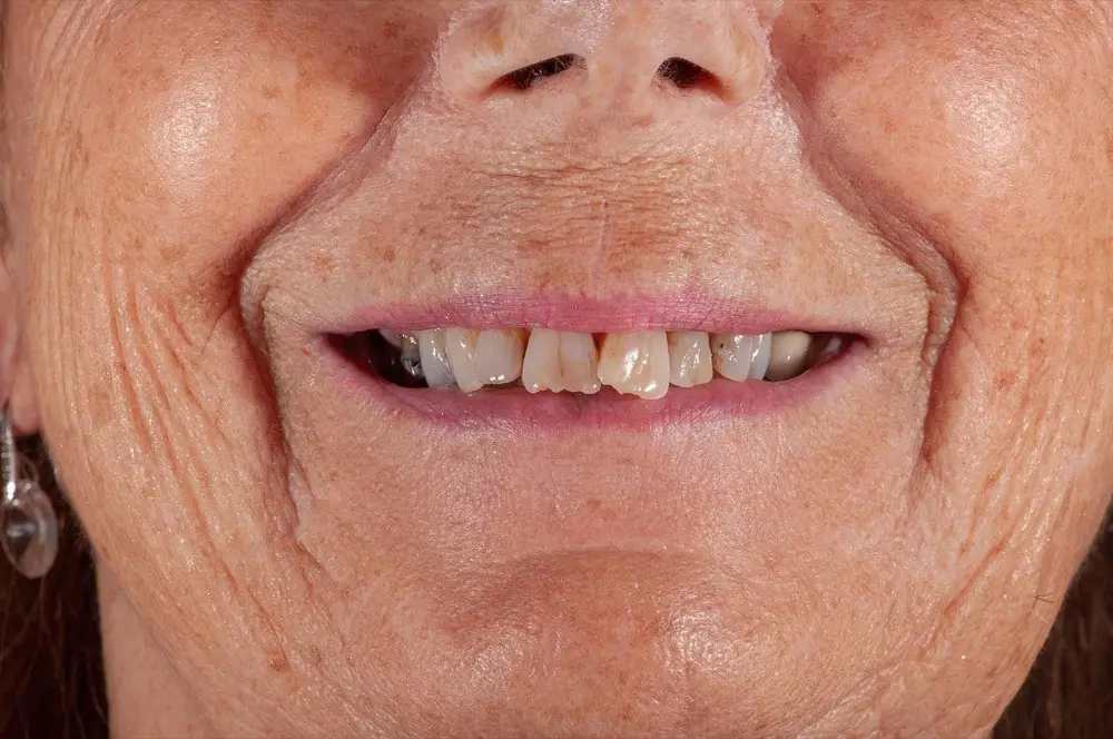 Zirconium crowns: Precious Dental patient before treatment