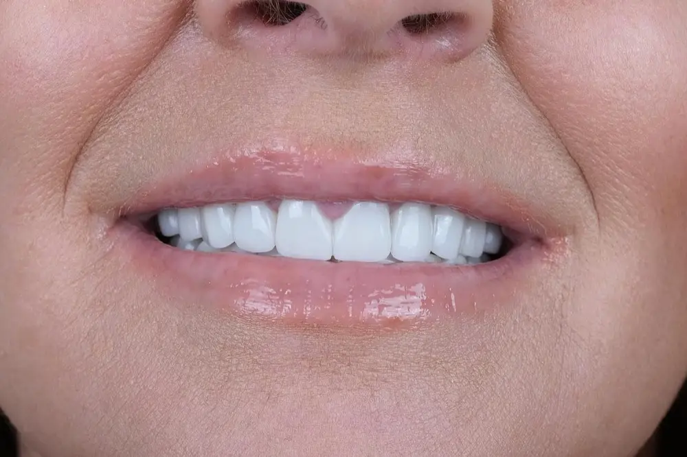 Hollywood smile: the same patient after treatment