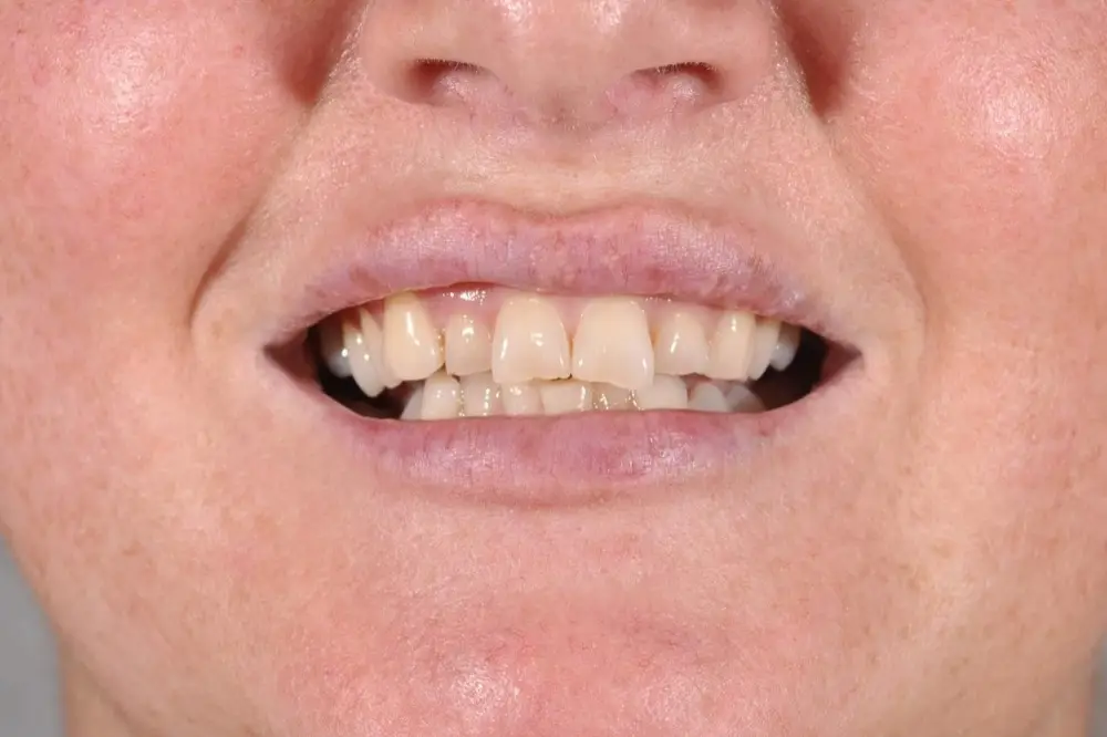 Hollywood smile: Precious Dental patient before treatment