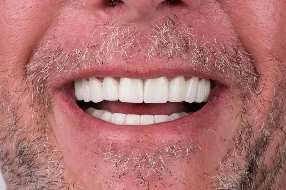 Full-mouth crowns: the same patient after treatment