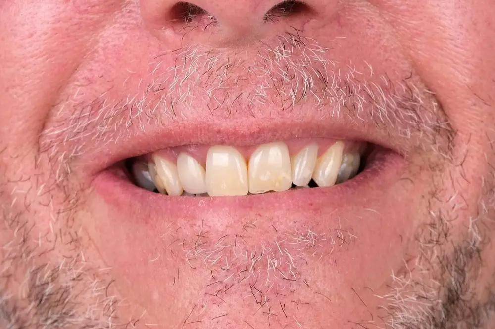 Full-mouth crowns: Precious Dental patient before treatment