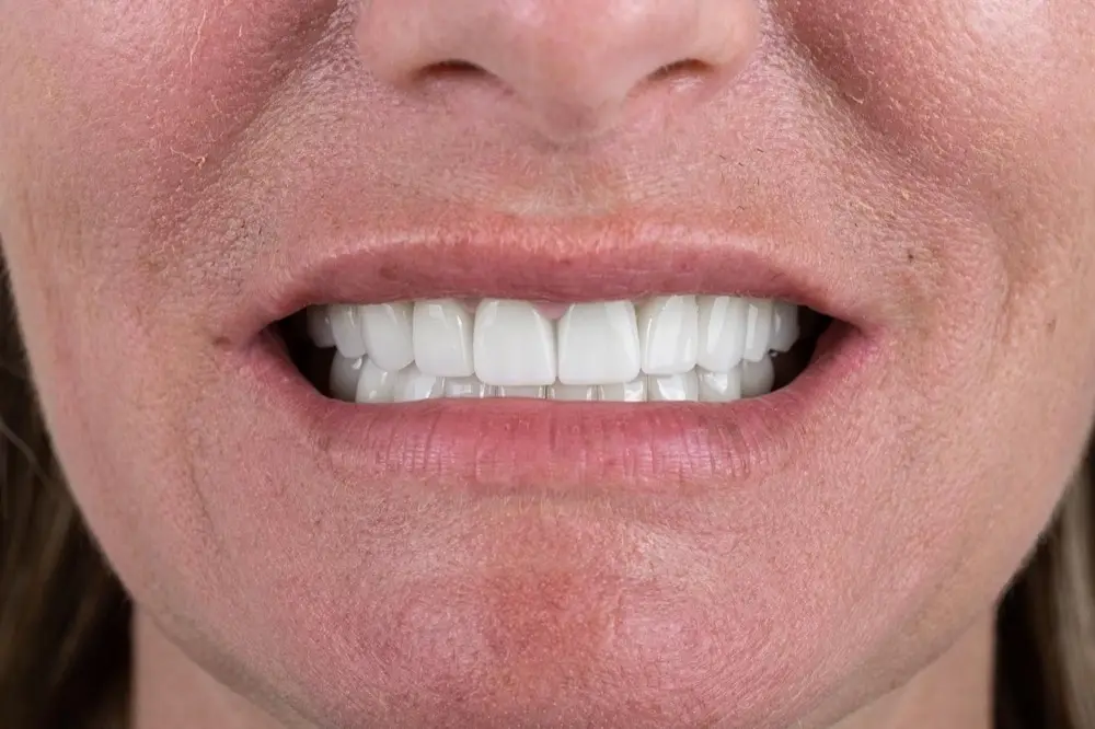 Zirconium crowns: the same patient after treatment