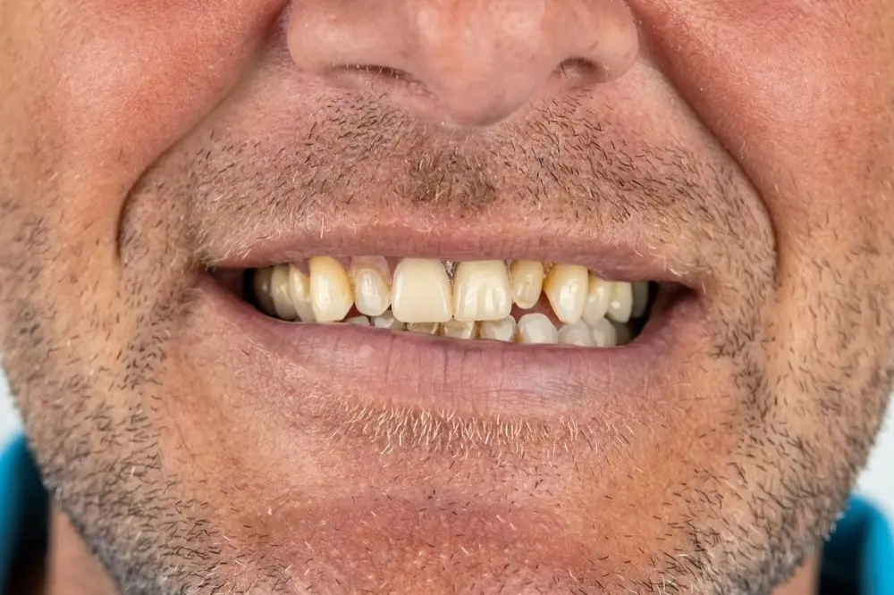 Zirconium crowns: Precious Dental patient before treatment