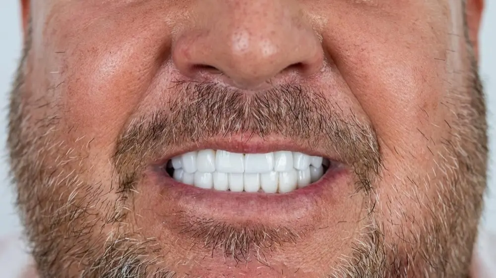 Smile makeover: the same patient after treatment