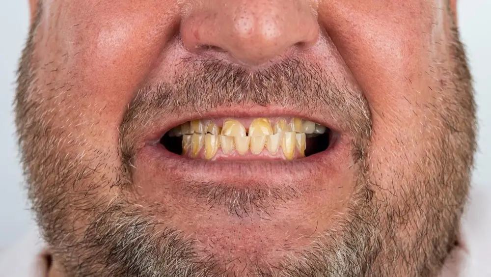 Smile makeover: Precious Dental patient before treatment