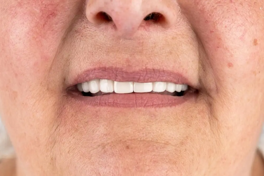 E-max veneers: the same patient after treatment