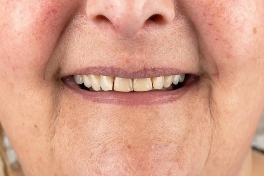 E-max veneers: Precious Dental patient before treatment