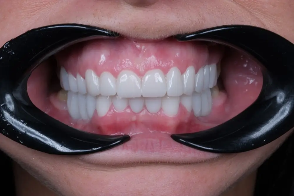 Smile makeover: the same patient after treatment