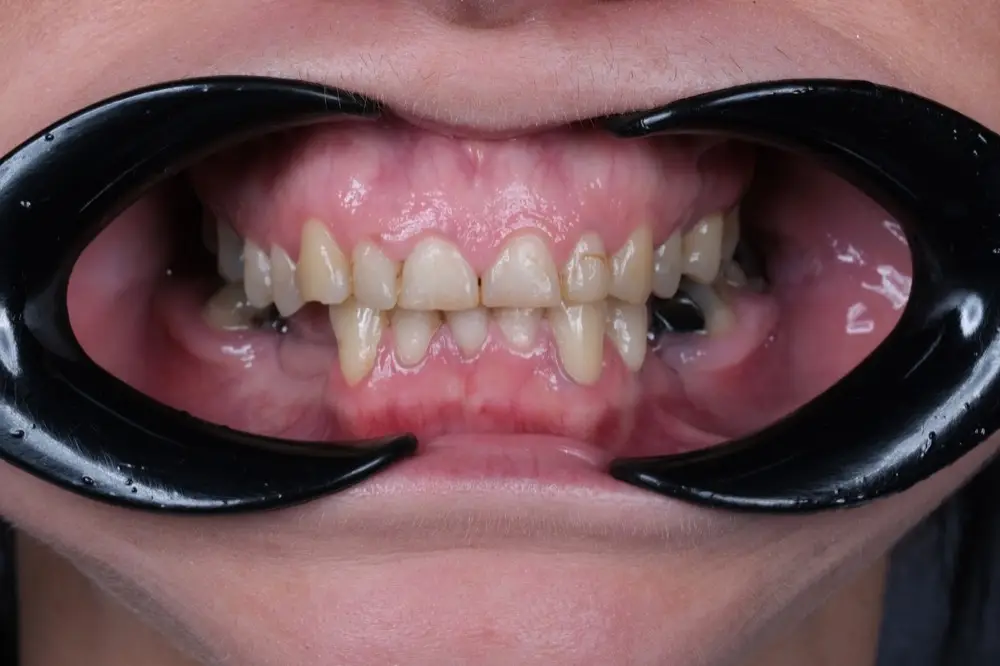 Smile makeover: Precious Dental patient before treatment