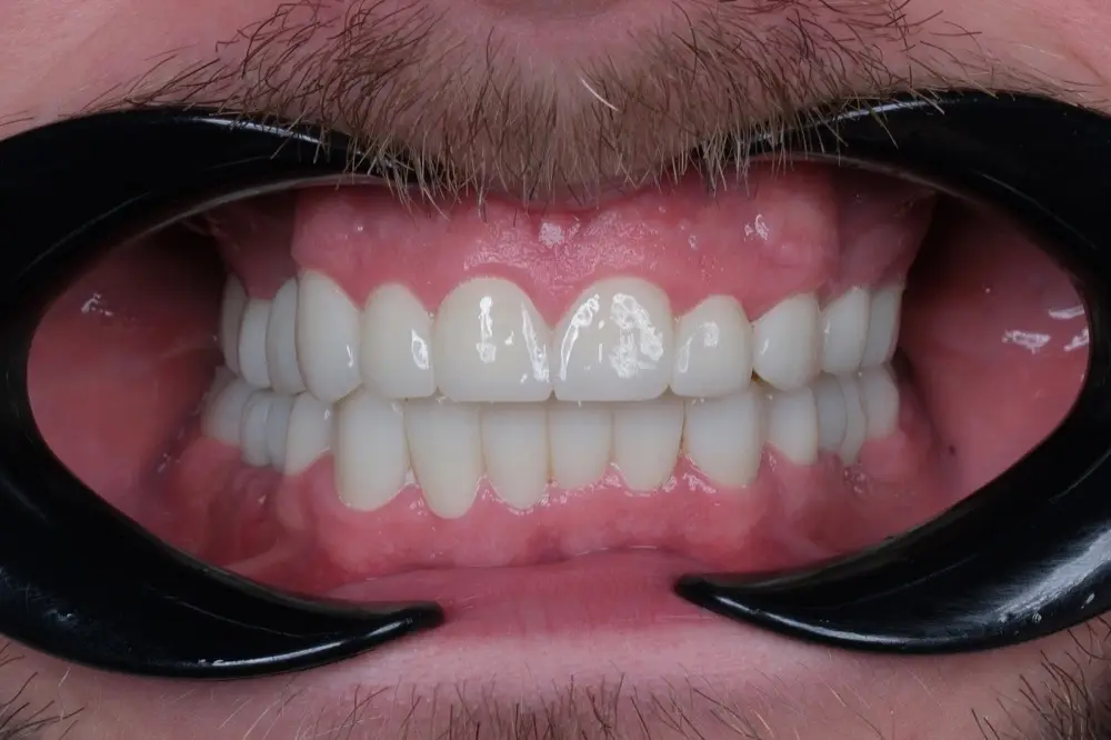 Smile makeover: the same patient after treatment