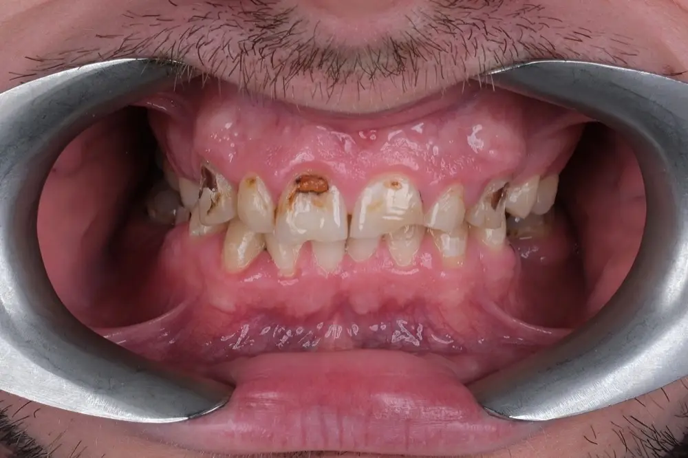 Smile makeover: Precious Dental patient before treatment