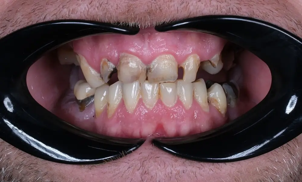 Smile makeover: Precious Dental patient before treatment